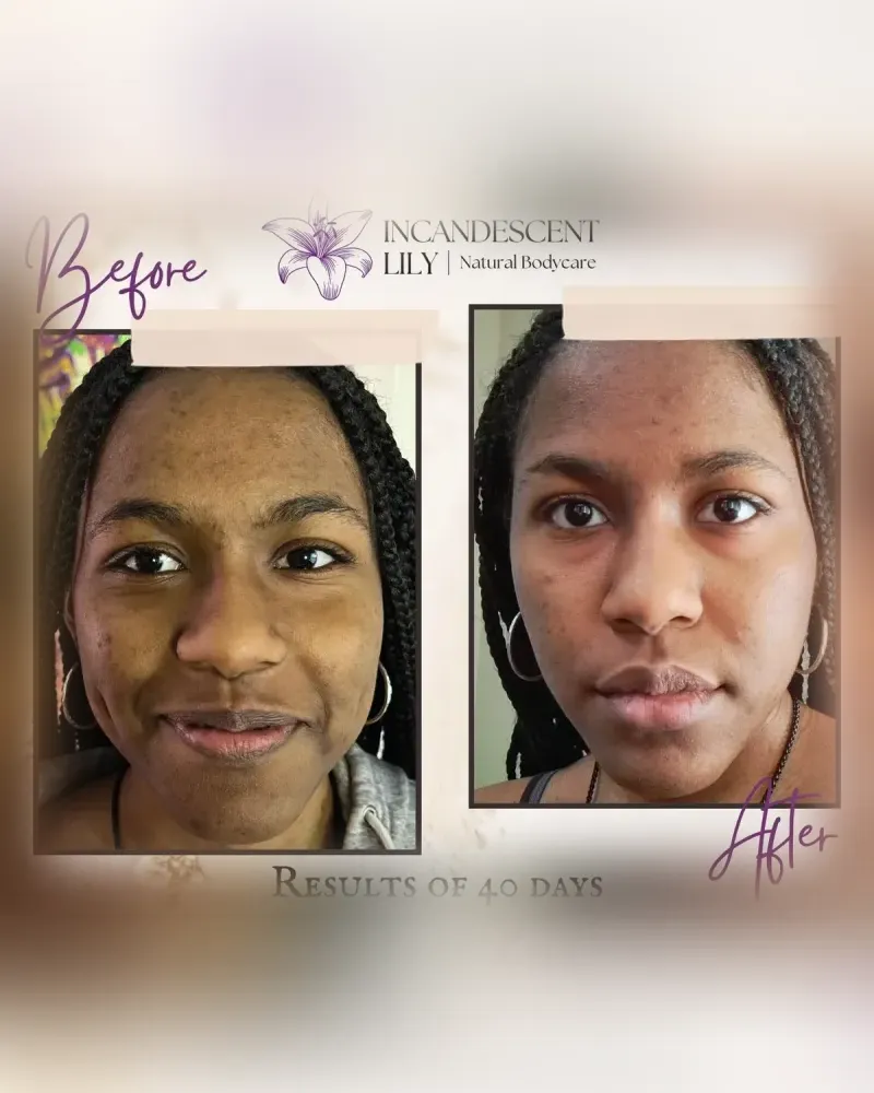 Before and after: 4-Step Miracle Kit, Results of 40 days