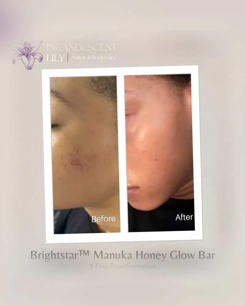Before and after: Brightstar™ Manuka Honey Glow Bar, 3-day transformation